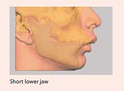jaw malalignment surgical treatment