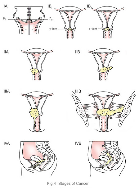 Stages of cervical cancer - KKH