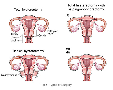 Cervical cancer types of surgery - KKH