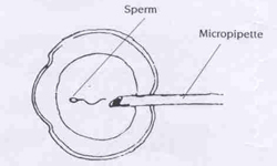 In-Vitro Fertilisation (IVF) injecting single sperm into an egg - KKH
