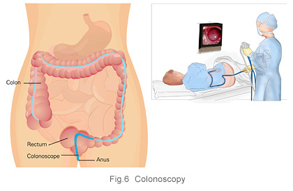 Ovarian cancer diagnosis - colonoscopy at KKH