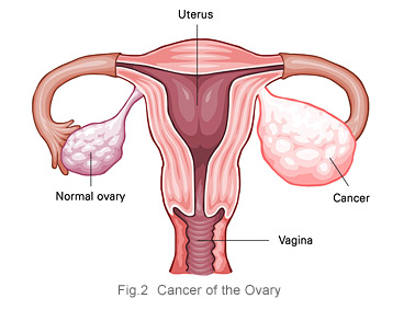 Ovarian cancer of the ovary KKH