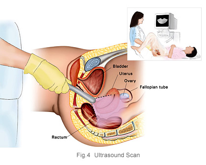 Ovarian cancer diagnosis ultrasound scan at KKH