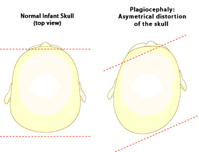 Plagiocephaly if not treated it may change their physical appearance by causing uneven growth of their face and head - KKH