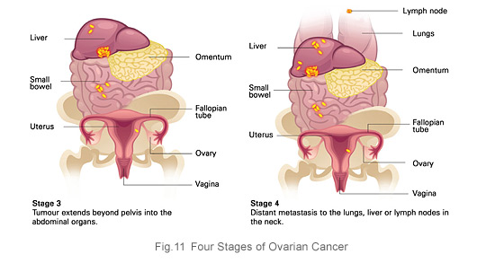 4 stages of ovarian cancer KKH
