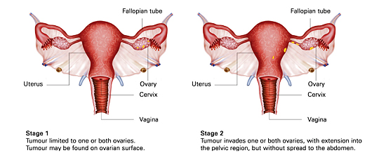 4 stages of ovarian cancer KKH