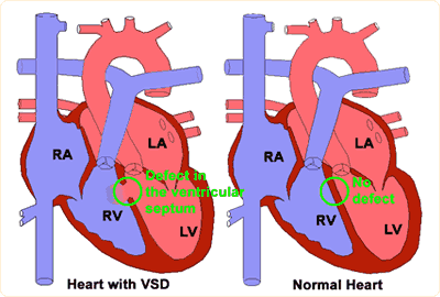 Heart with VSD and normal heart - KKH
