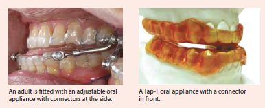 An adjustable oral appliance with connectors at the side, A Tap-T oral appliance with a connector in front, by NDCS