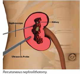 percutaneous nephrostomy as a treatment for kidney stones