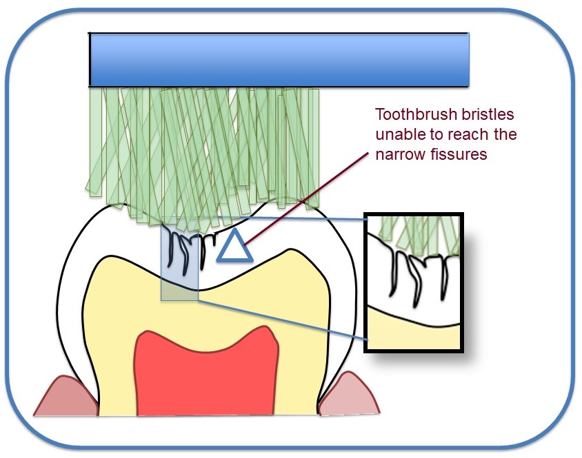 Fissures are so narrow that you are unable to clean them effectively by the National Dental Centre Singapore