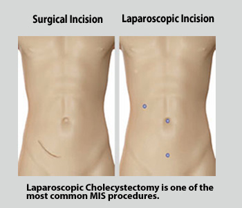 Laparoscopic Appendicectomy Singapore General Hospital