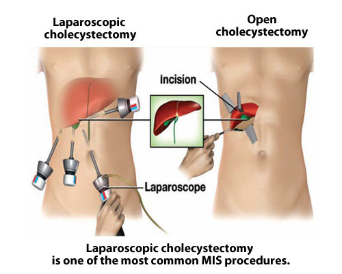Laparoscopic cholecystectomy Singapore General Hospital