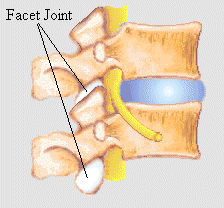 Facet Joint Syndrome and Treatment