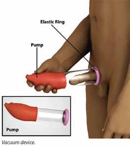 erectile dysfunction treatment vacuum device