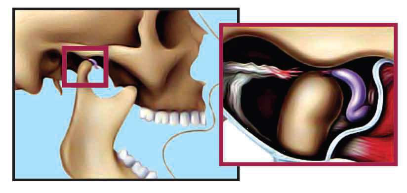 Abnormal Temporomandibular Joint