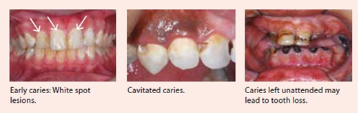 tooth-decay-national-dental-cenre-singapore