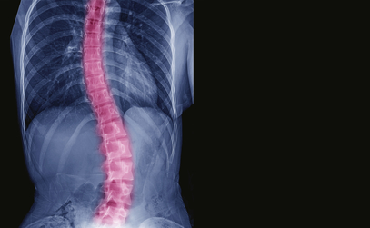 Safer, Faster Surgery for Scoliosis