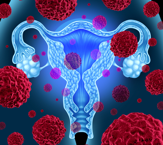 Ovarian Cancer: Surgery, Chemotherapy and Prevention