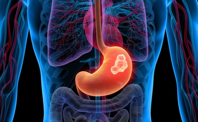 How to Prevent and Treat Stomach Cancer 