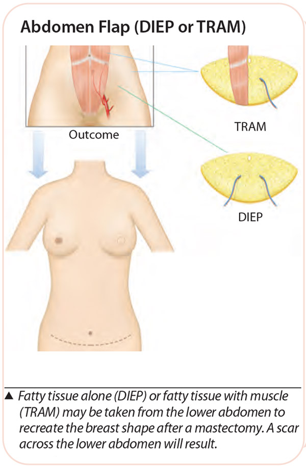 Abdomen Flap (DIEP or TRAM) - Flap reconstructions Breast Surgery